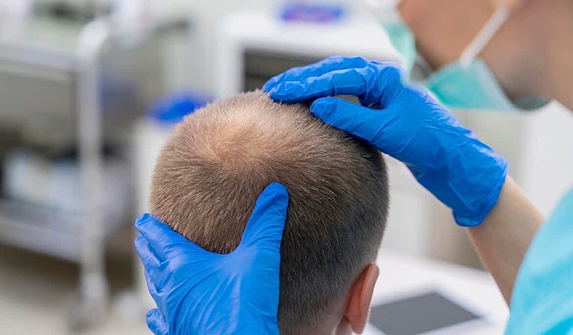 Hair Transplant