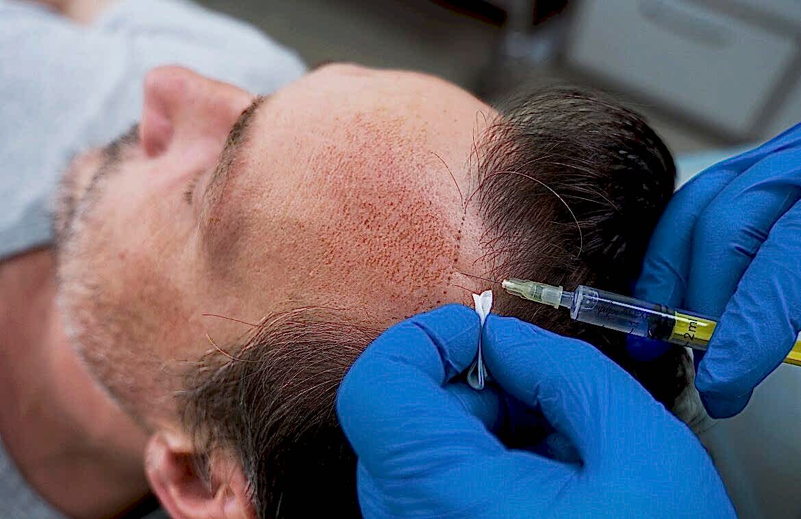 Hair Transplant